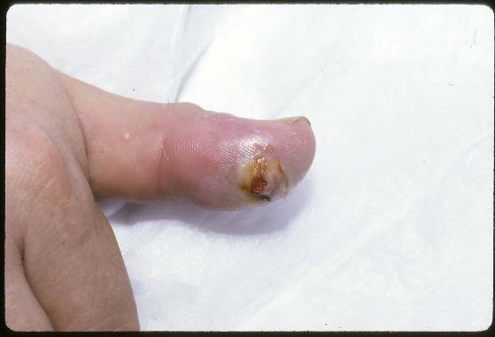 Animal Bite Infections: Definition and Patient Education