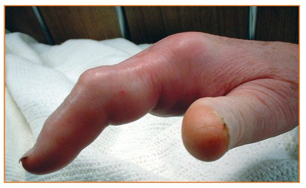 What happens after surgical removal of a ganglion cyst on the middle little finger joint?
